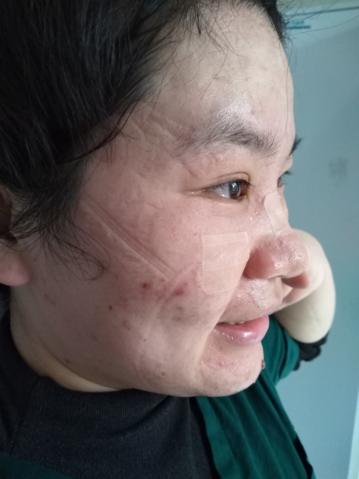 摘下防護面罩，護士臉上留下深深印痕,。市一醫(yī)院 供圖