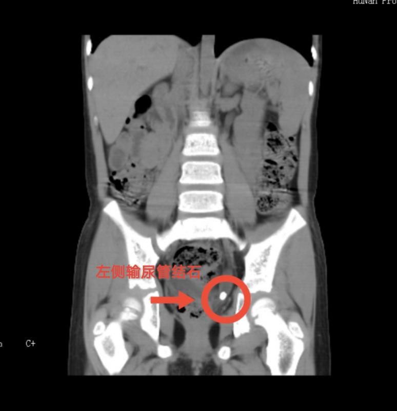 經(jīng)詳細(xì)檢查,，患兒被診斷為左腎積水伴左側(cè)輸尿管下段結(jié)石。