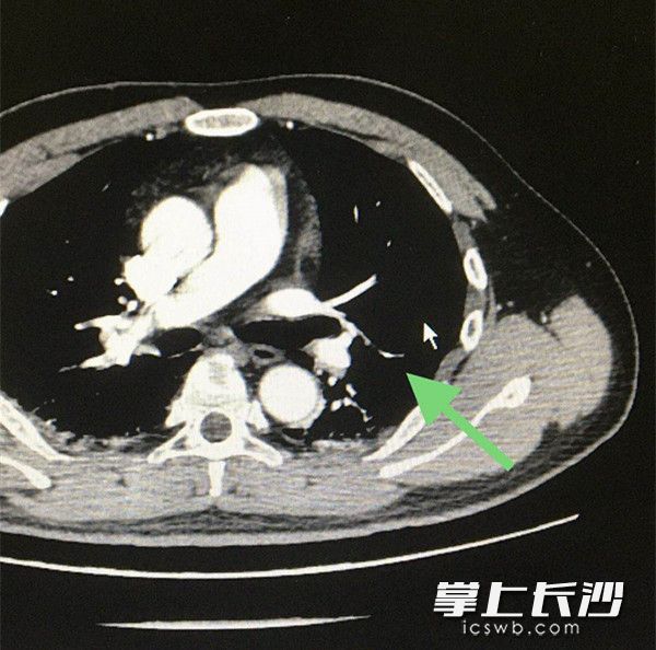從患者的肺血管造影檢查可示,，左肺下葉肺動(dòng)脈分支可見線性充盈缺損，提示肺栓塞,。