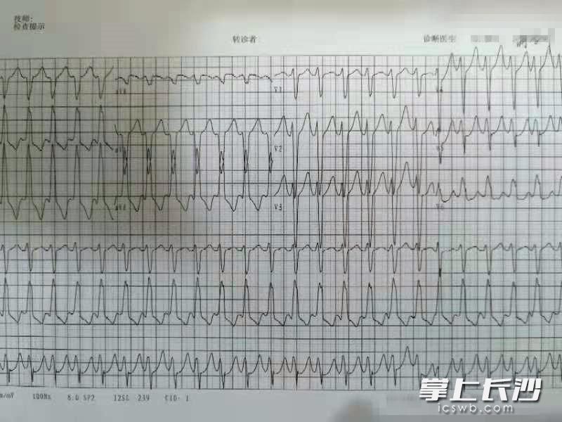 韓女士的心電圖顯示室性心律失常,。均為長沙晚報(bào)通訊員 吳威 供圖