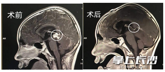 手術(shù)成功切除了患兒腦深部腫瘤,。  湘雅醫(yī)院供圖