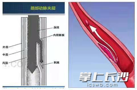 頸內(nèi)動(dòng)脈夾層