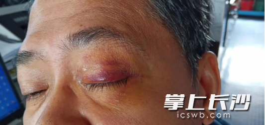 患者左眼被氣動(dòng)砂輪切割片割傷,，淚流不止。